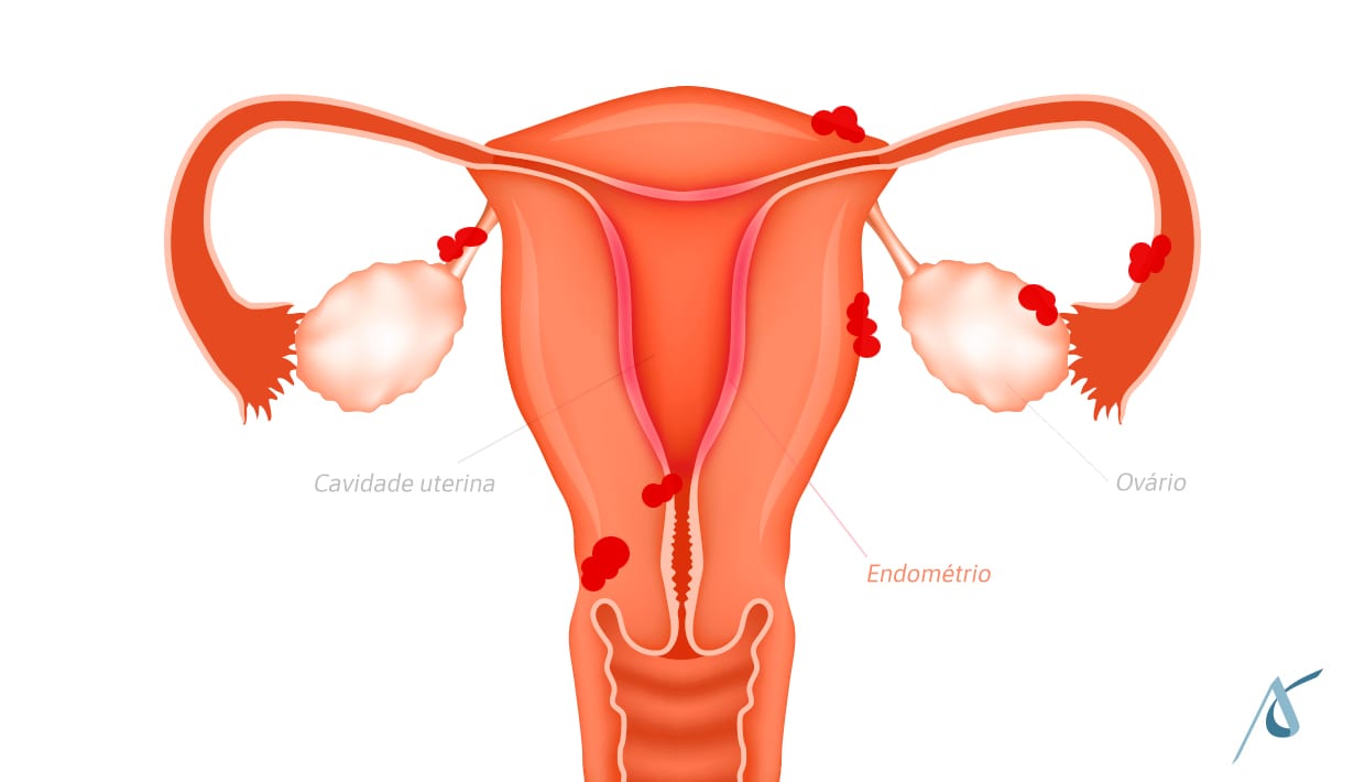 Endometriose