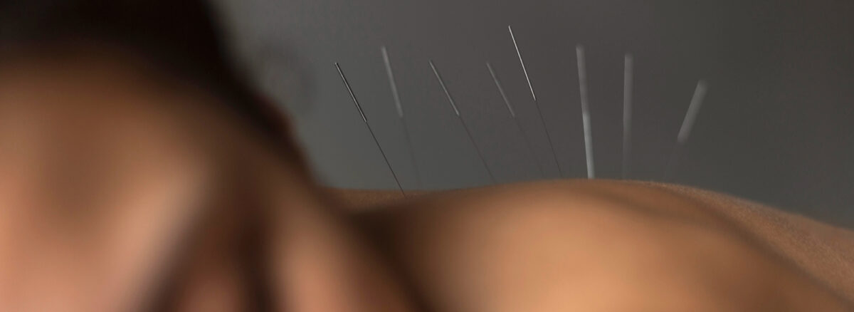 Acupuntura