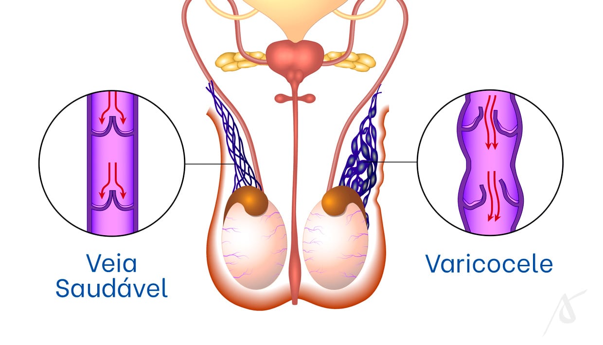 Varicocele