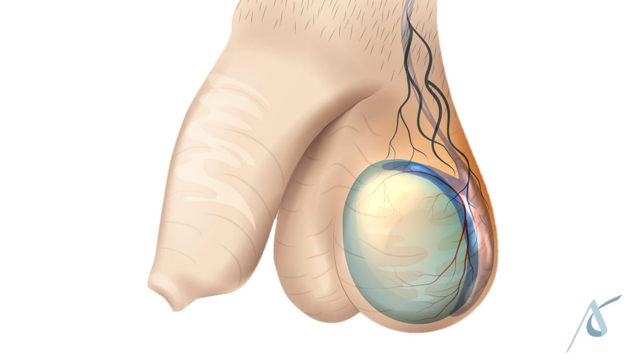 Varicocele