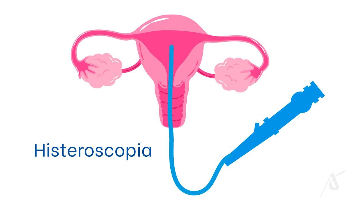 Histeroscopia cirúrgica