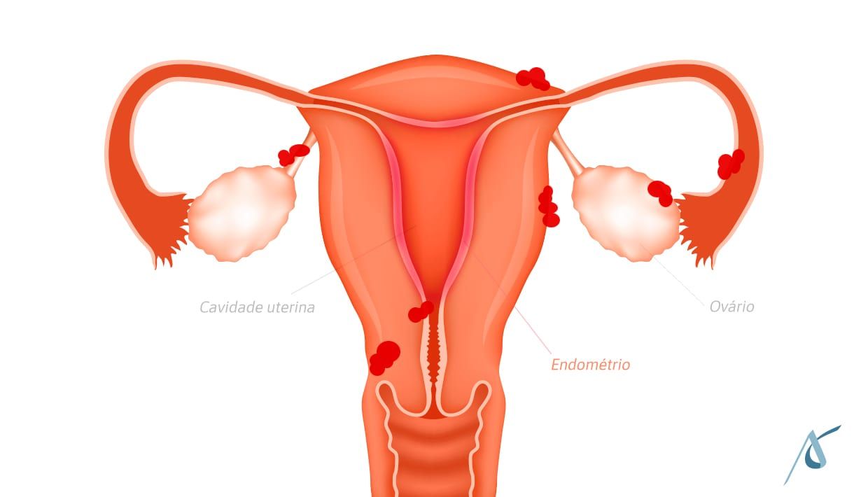 Endometriose