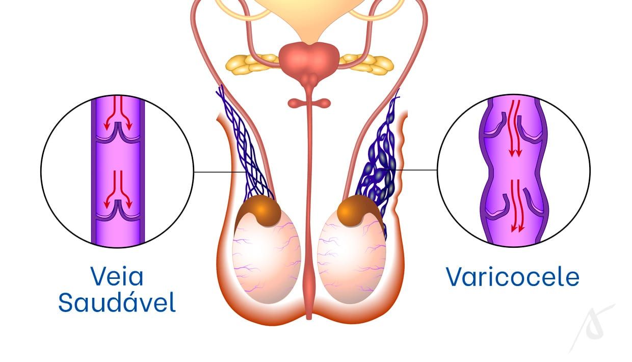 Correção da varicocele